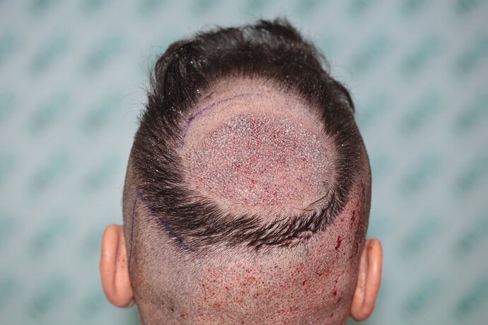 Crown Result of 3rd FUE for 2410 Grafts – HDC Hair Clinic photo