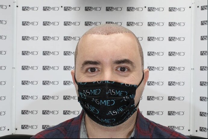 ASMED CLINIC - DR.KORAY - 5060 GRAFTS FUE photo