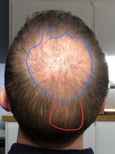 Hair Transplant Result - 10 months after – 5750 grafts in 2 FUE Sessions- Dr Christina – HDC Hair Clinic photo