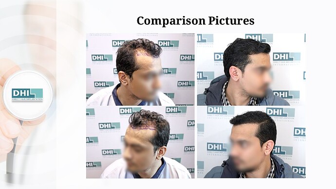 DHI India | NW 2 | 1,359 Grafts | 7-Months DHI Hair Transplant Results photo