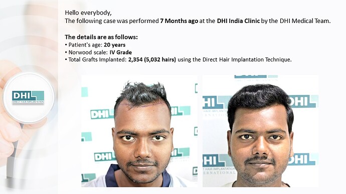 DHI India | NW 4 | 2,354 Grafts | 7-Months DHI Hair Transplant Results photo