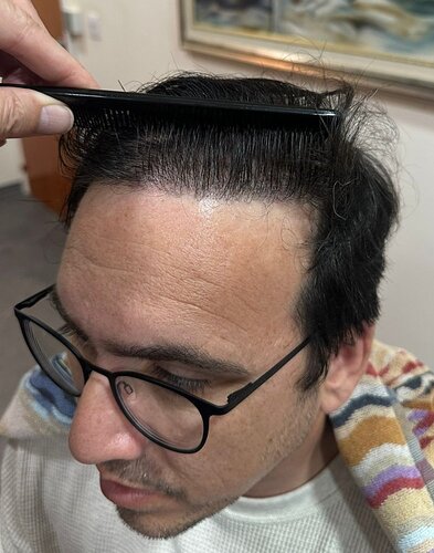 HDC Hair Clinic – FUE Hair Transplant Result for 4534 Grafts photo