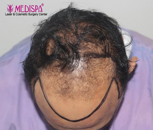 Dr. Suneet Soni - 5000 Grafts, Combine FUT + FUE + Beard, NW-VI photo