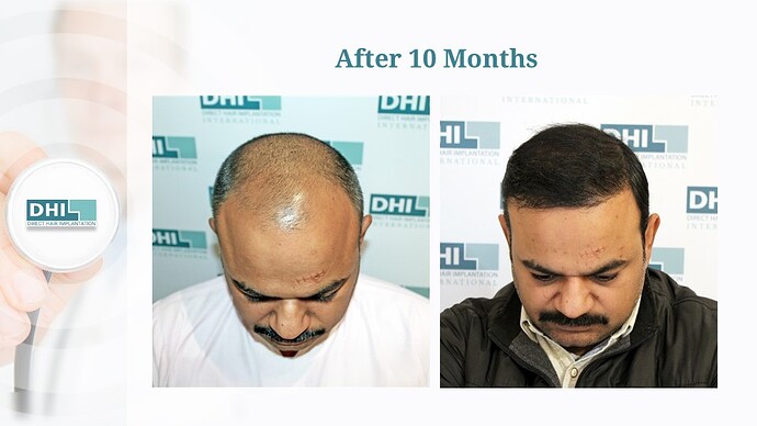 DHI India Result - 1,615 grafts photo