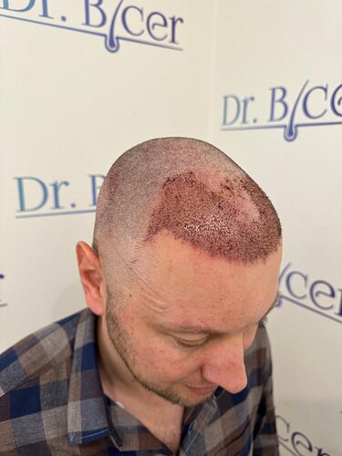Ozlem Bicer MD-Hair Transplant-2910 Grafts FUE by micro-motor, 7. months result photo