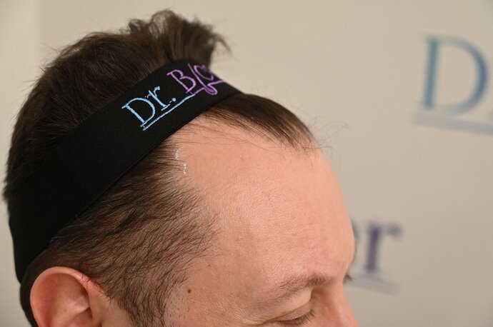 Ozlem Bicer MD-Hair Transplant-2910 Grafts FUE by micro-motor, 7. months result photo