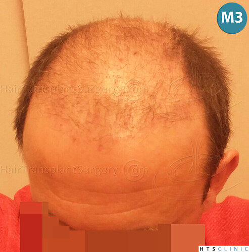 Dr. Jean Devroye, HTS Clinic / 2238 FUE / NW VI, 1st session photo