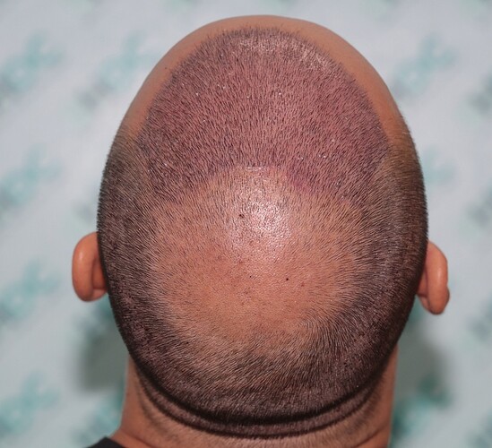 Two FUE Surgeries Totaling 6560 Grafts – HDC Hair Clinic photo