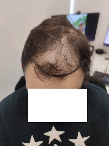 FUE Result 3 Years after for 3520 grafts – NW Class 4 – HDC Hair Clinic – Dr Maras photo