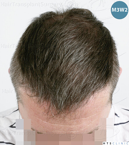 Dr. Jean Devroye, HTS Clinic / 5913 grafts (3036 FUE + 2877 FUE-BHT) / 2 sessions photo