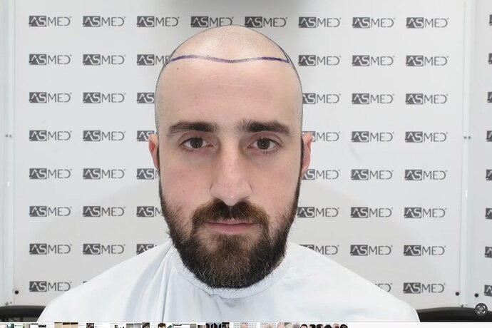 ASMED CLINIC CASE - DR.KORAY 5000 GRAFTS FUE photo