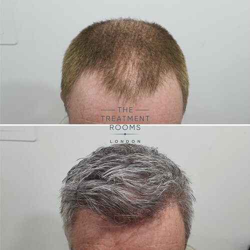 2322 Grafts Hairline and Crown FUE Hair Transplant photo