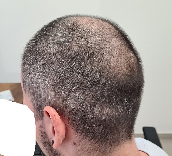 FUE Result for 4400 Grafts – 6 Months after – HDC Hair Clinic photo