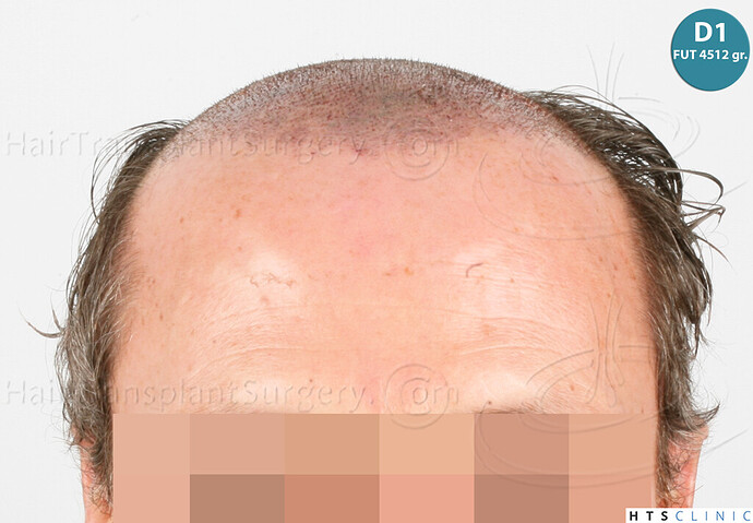 Dr Devroye + Dr Montesanti + Dr Jenard / 7015 grafts (4512 FUT + 2503 FUE) / 2 sessions photo