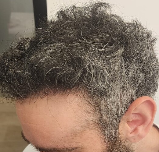 Result of Class 3V Patient – 3530 Grafts – HDC Hair clinic – Dr Maras photo