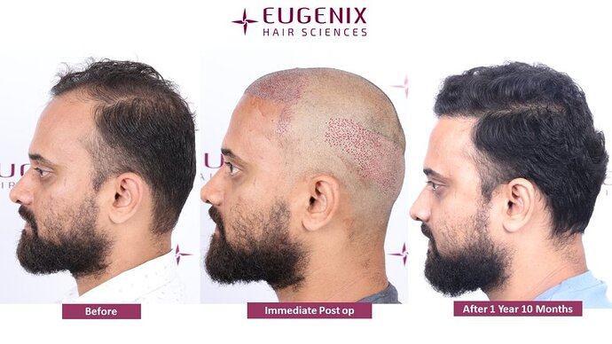 Eugenix Hair Sciences Clinic | Norwood Grade 3 | 22 Months Hair Transplant Results| photo