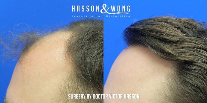 Dr. Hasson / 4,511 grafts / FUE / Frontal zone /mid / 3 years post-op photo