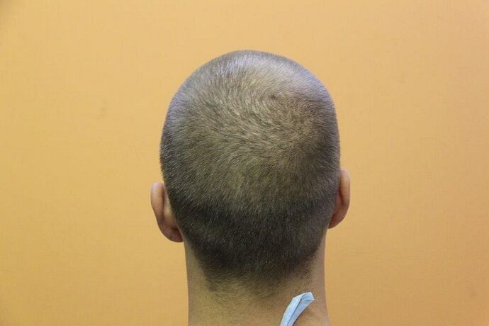 Dr.Bisanga, BHR Clinic, 2485 FUE 0 - 8 Months photo