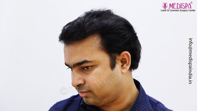 Dr. Suneet Soni - 5000 Grafts, Combine FUT + FUE + Beard Technique, NW-V photo