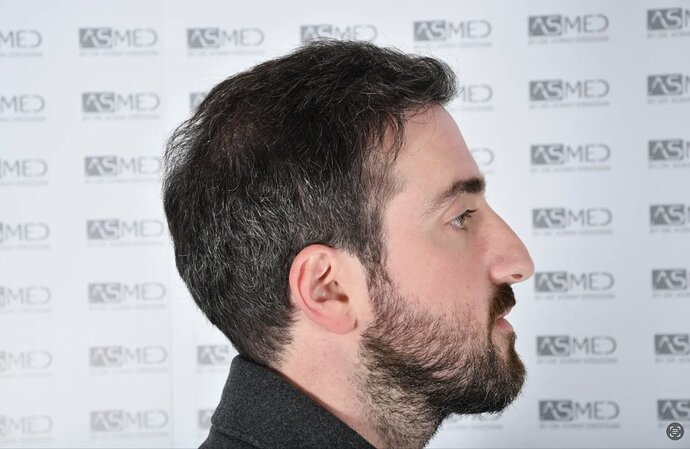 ASMED CLINIC CASE - DR.KORAY 5000 GRAFTS FUE photo