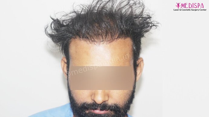 Revision Hair Transplant - 5111 Grafts / 5 Years Result - Dr. Suneet Soni, Medispa India photo