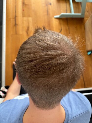 Ozlem Bicer MD-Hair Transplant-2720 Grafts FUE by micro-motor, 9. months result photo