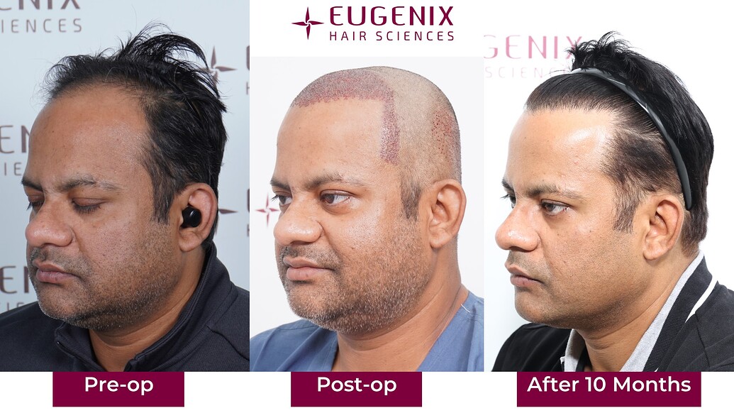 https://cdn.forumhairtransplant.com/optimized/3X/a/c/ac335ac9b93b9c389d53ff5ede772da4b11e225e_2_1035x582.jpeg