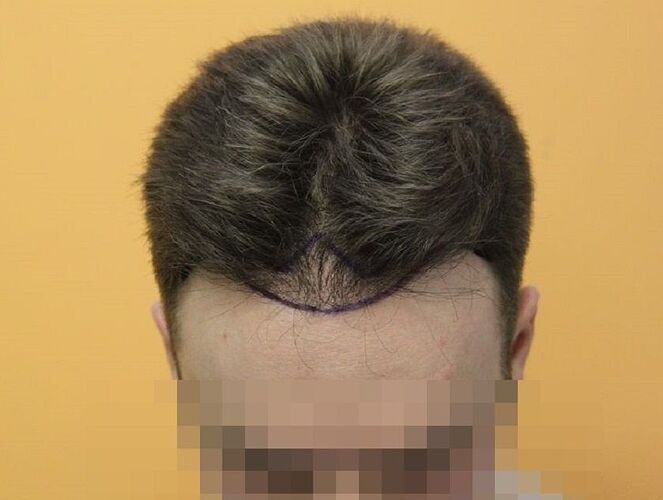 Dr.Bisanga, BHR Clinic, 1675 FUE, 0 - 13 Months photo