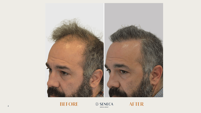 Seneca Medical Group - 1533 grafts with Direct FUE photo