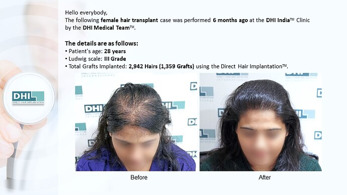 Female Hair Transplant | 1,359 Grafts | 6-Months Result | DHI India™ photo