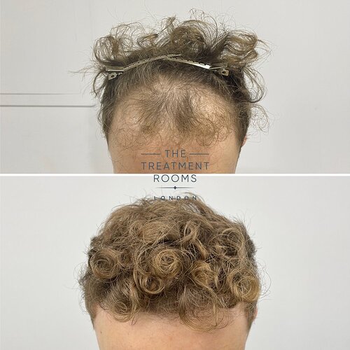 1514 Grafts Hairline Hair Transplant- The Treatment Rooms London photo