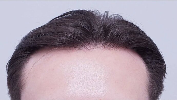 Dr Bessam Farjo FUE 1720 grafts to frontal recessions photo