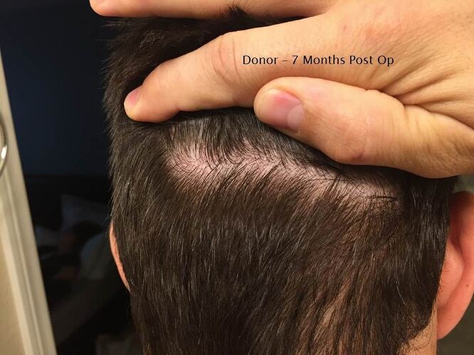 Dr. Ron Shapiro – 7 Months FUE Result-2606gr/5364 hairs photo