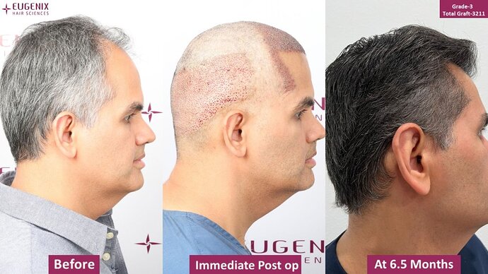 EUGENIX HAIR SCIENCES | NW3 | 6.5 MONTHS RESULT | DR. ARIKA BANSAL photo