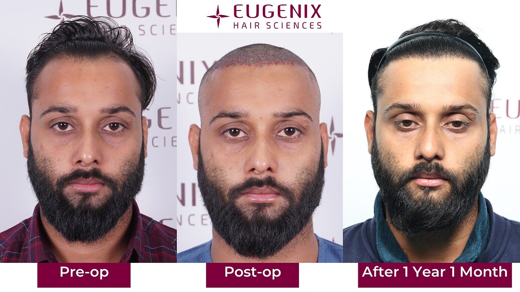 https://cdn.forumhairtransplant.com/optimized/3X/a/d/ad2a98816717989162d6a675a86e6fa9117476ab_2_1035x582.jpeg