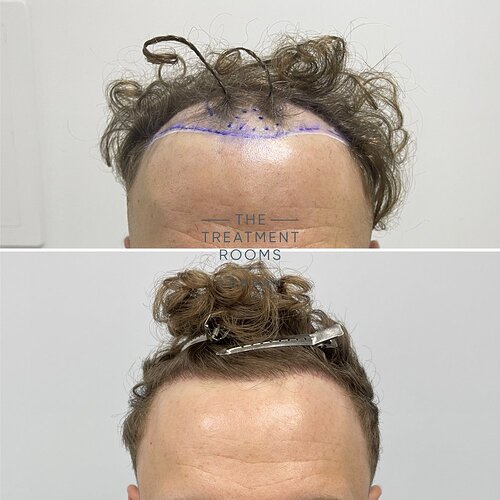 1514 Grafts Hairline Hair Transplant- The Treatment Rooms London photo