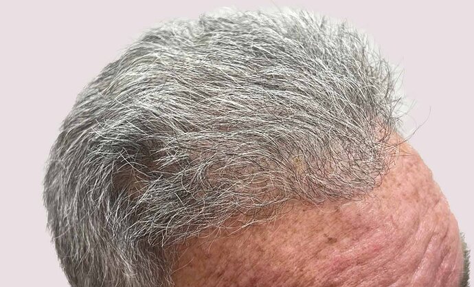 Dr B Farjo 2000-2023 Patient using both FUT and FUE, photo