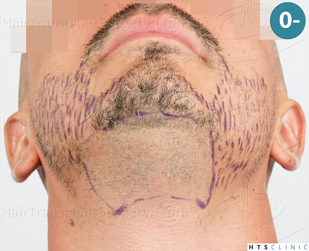 Dr. Jean Devroye, HTS Clinic / 2191 FUE (1292 + 899) / Beard restoration photo