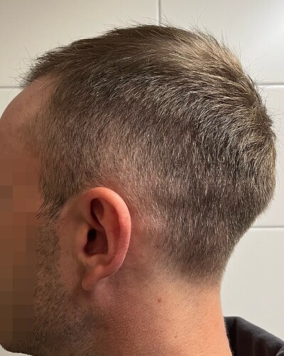 Dr. Bisanga + Dr. Kostis - BHR Clinic - Fine Hair - 2800 Grafts - 0 - 13 Months photo