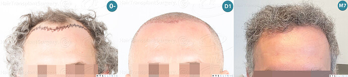 Dr Devroye + Dr Montesanti + Dr Jenard, HTS Clinic / 2932 FUE / Hairline & frontal area photo