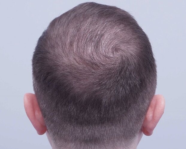 FUE Hair Transplant - 2,300 Grafts - Dr Bessam Farjo photo