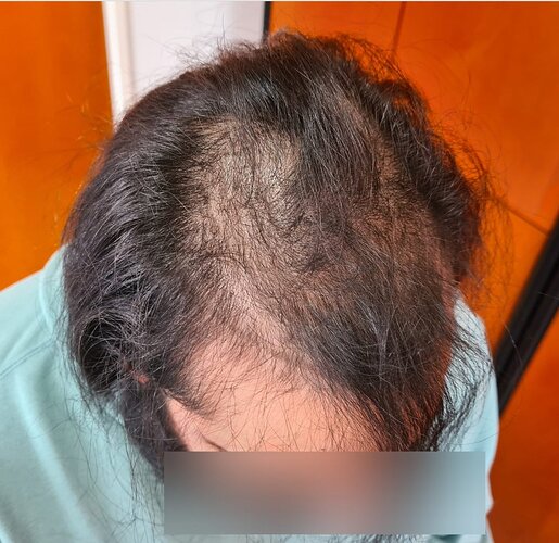 Density Enhancement Result for 4516 FUE Grafts – HDC Hair Clinic – 1 Year Post-Procedure photo