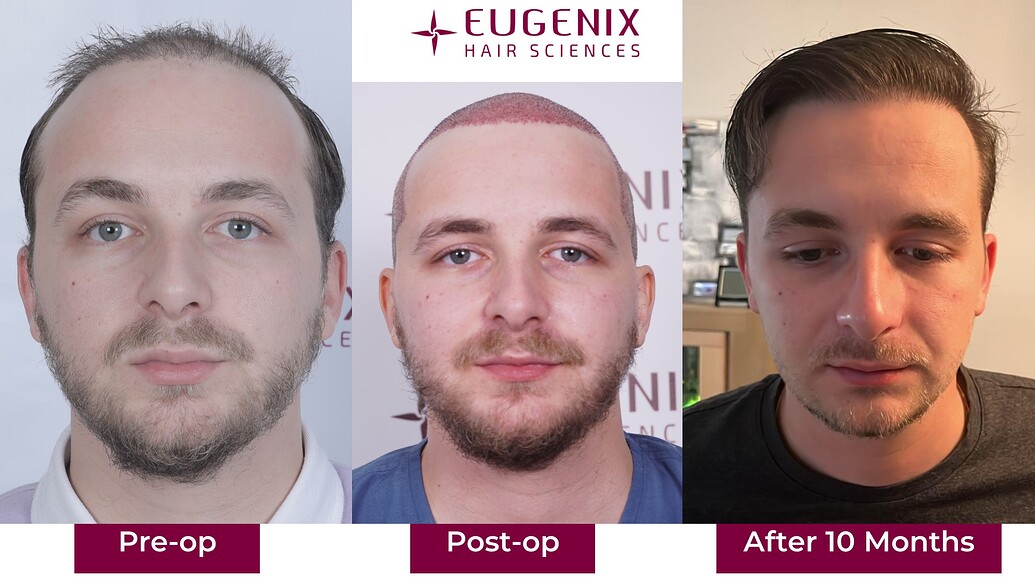 https://cdn.forumhairtransplant.com/optimized/3X/a/d/ade1e4a404bf5d132e3b93390497d683f9381c0a_2_1035x582.jpeg