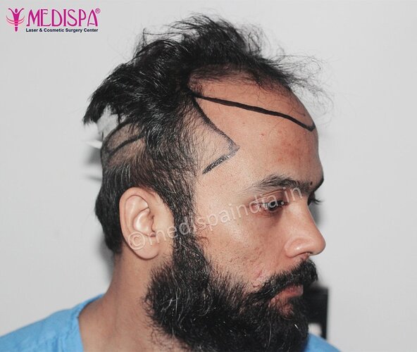 Dr. Suneet Soni - 5320 Grafts, Combine FUT + FUE Technique , NW- IV photo