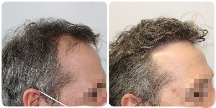 Dr Bonaros, Glasgow, UK / 3595 FUE grafts / 0-12 Months photo