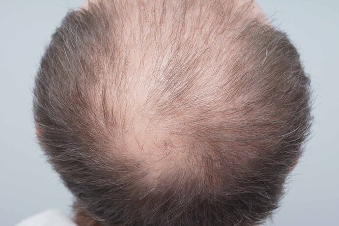 Dr B Farjo - FUE - 2091 Grafts photo