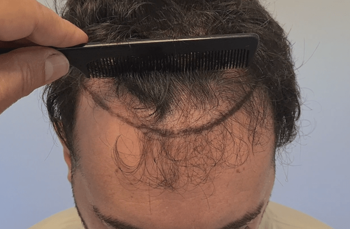 Result of NW3 patient after 3230 grafts after 7 months – HDC Hair Clinic – Dr Christina photo