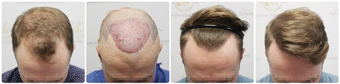 Dr Bonaros, Glasgow, UK / 1819 FUE grafts / 0-12 Months photo