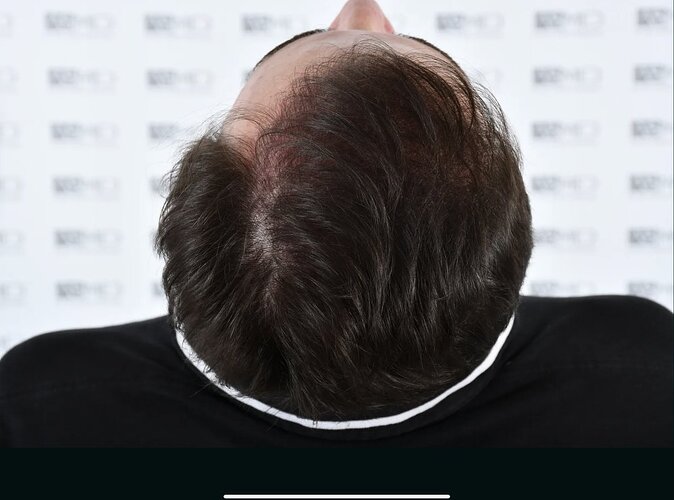 ASMED CLINIC - DR.KORAY - 5060 GRAFTS FUE photo