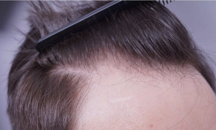 Dr Bessam Farjo FUE 1720 grafts to frontal recessions photo